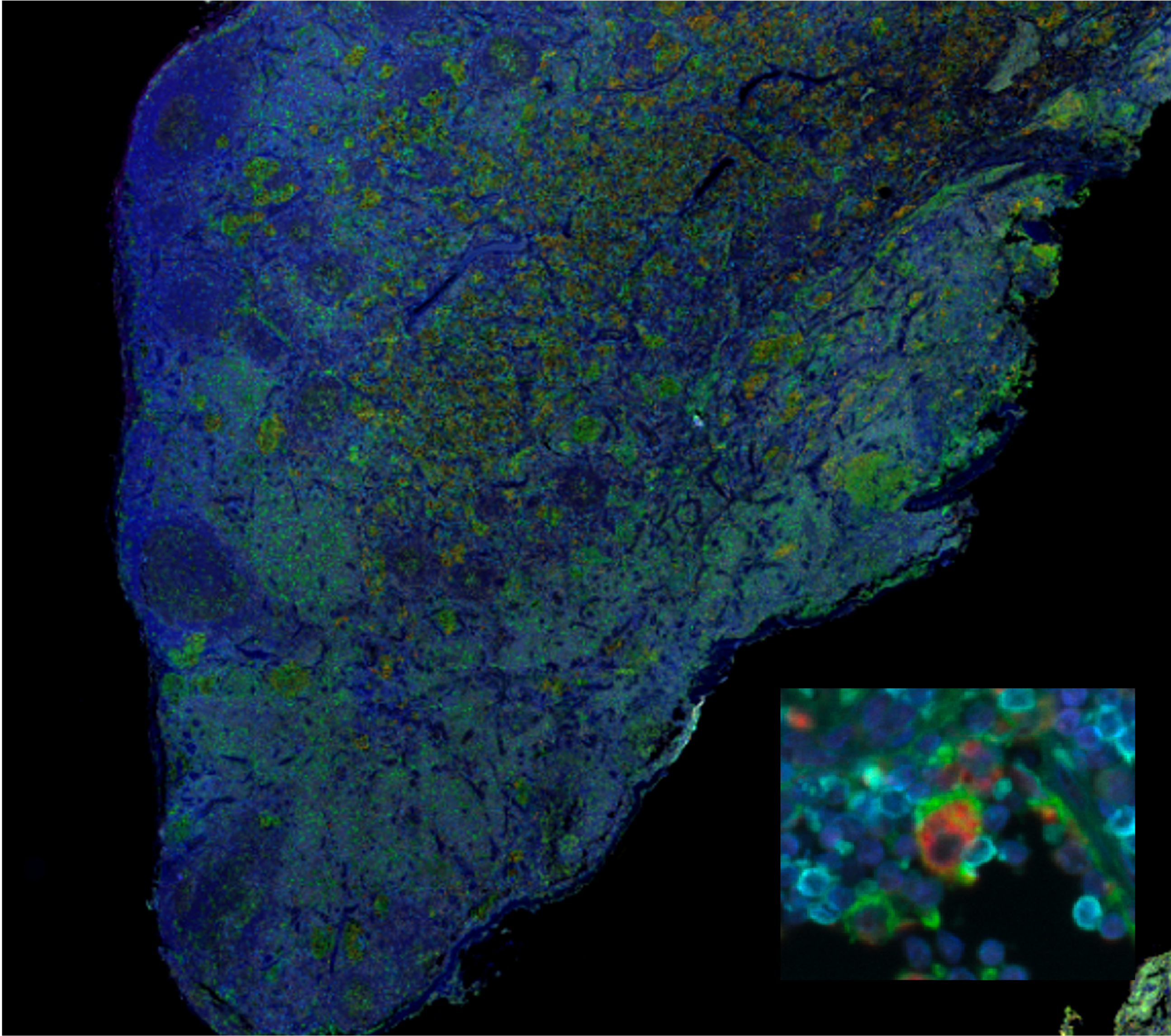Multiplex immunofluorescence of NSCLC tumor tissue